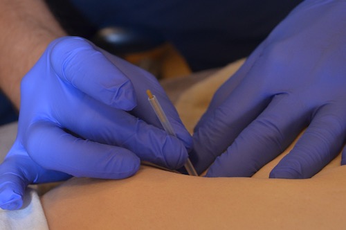 Dry Needling behandeling