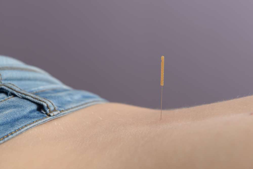 dryneedling bij Fysio Henk Scholing